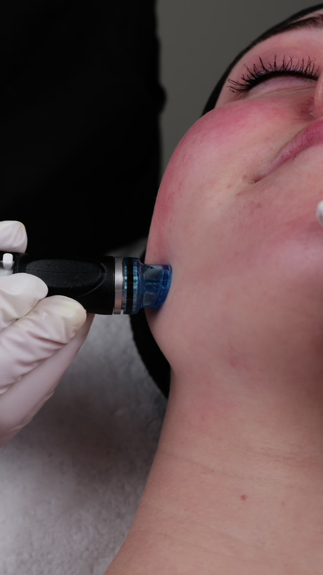 HydraFacial Behandlung bei Beauté Infinie Bern