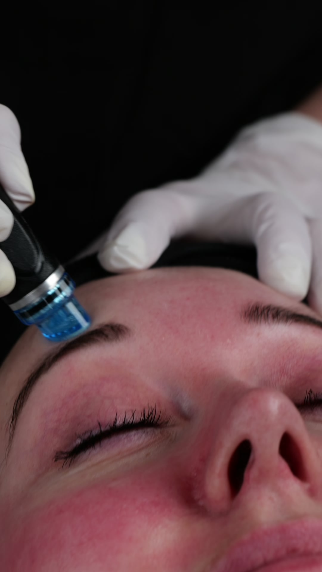 HydraFacial Behandlung im Augenbereich