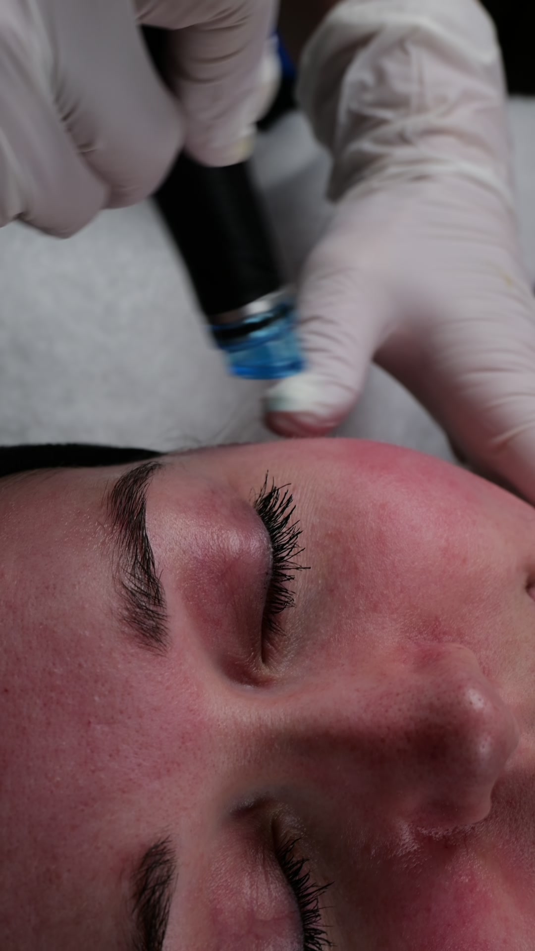 HydraFacial Vortex-Handstuck im Einsatz